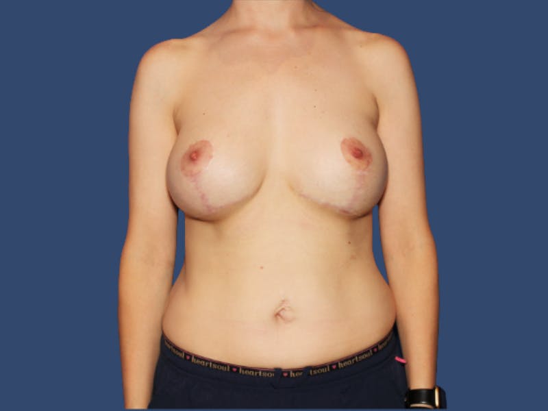 Breast Augmentation Before & After Gallery - Patient 165966 - Image 2