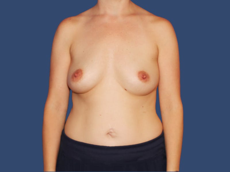 Breast Augmentation Before & After Gallery - Patient 165966 - Image 1