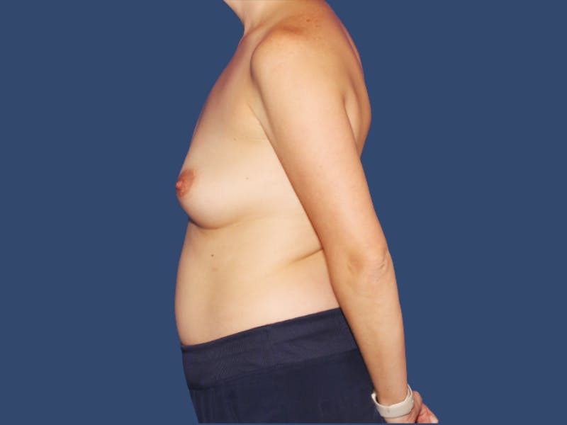 Breast Augmentation Before & After Gallery - Patient 165966 - Image 3