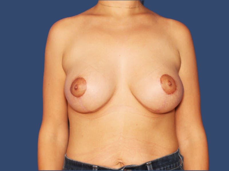 Breast Augmentation Before & After Gallery - Patient 400980 - Image 2