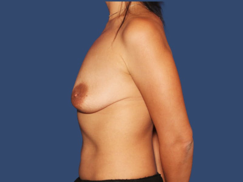 Breast Augmentation Before & After Gallery - Patient 400980 - Image 3