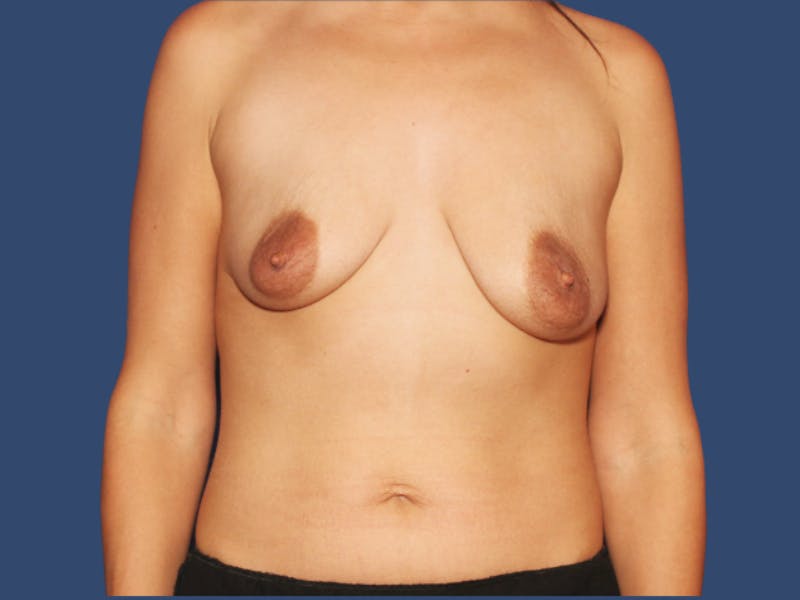 Breast Augmentation Before & After Gallery - Patient 400980 - Image 1