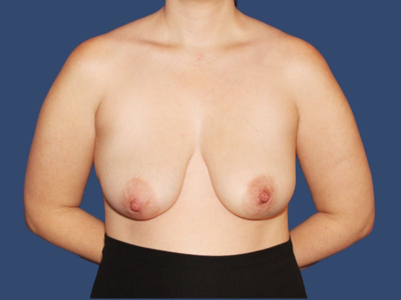 Breast Augmentation Before & After Gallery - Patient 389555 - Image 1
