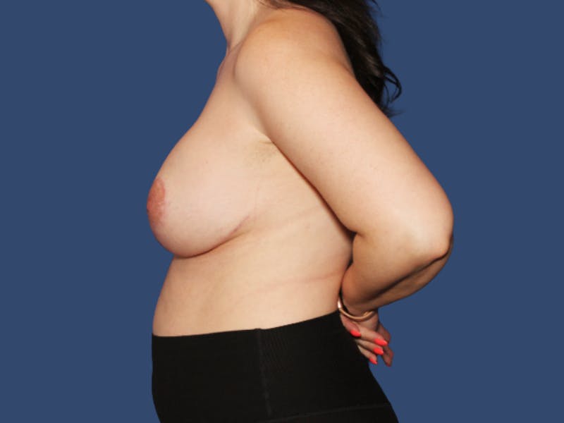 Breast Augmentation Before & After Gallery - Patient 389555 - Image 4