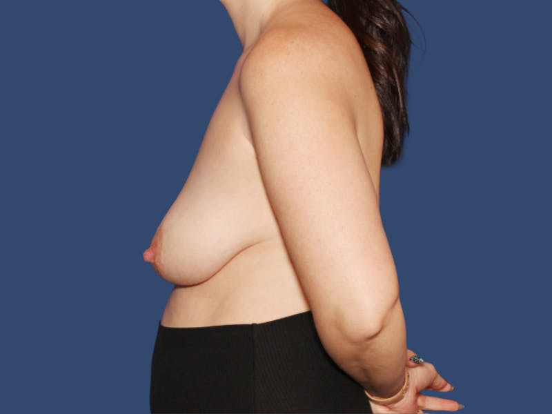 Breast Augmentation Before & After Gallery - Patient 389555 - Image 3
