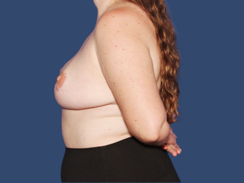 Breast Reduction Before & After Gallery - Patient 959594 - Image 4