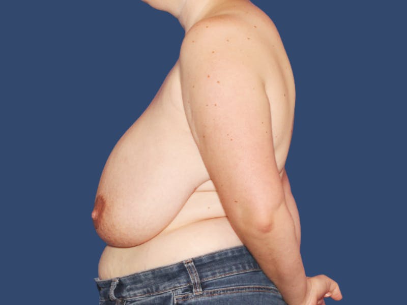Breast Reduction Before & After Gallery - Patient 959594 - Image 3