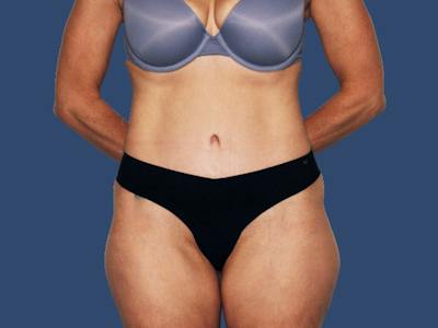 Tummy Tuck Before & After Gallery - Patient 167056 - Image 2