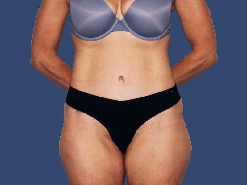 Tummy Tuck Before & After Gallery - Patient 167056 - Image 2