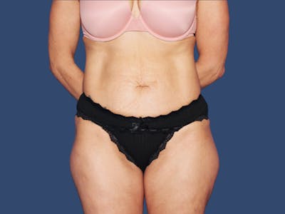Tummy Tuck Before & After Gallery - Patient 167056 - Image 1