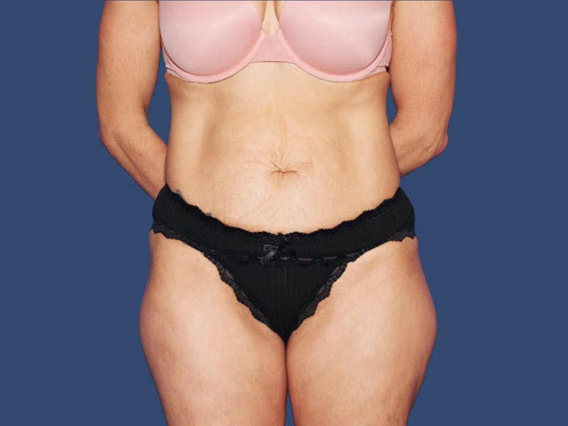 Tummy Tuck Before & After Gallery - Patient 167056 - Image 1