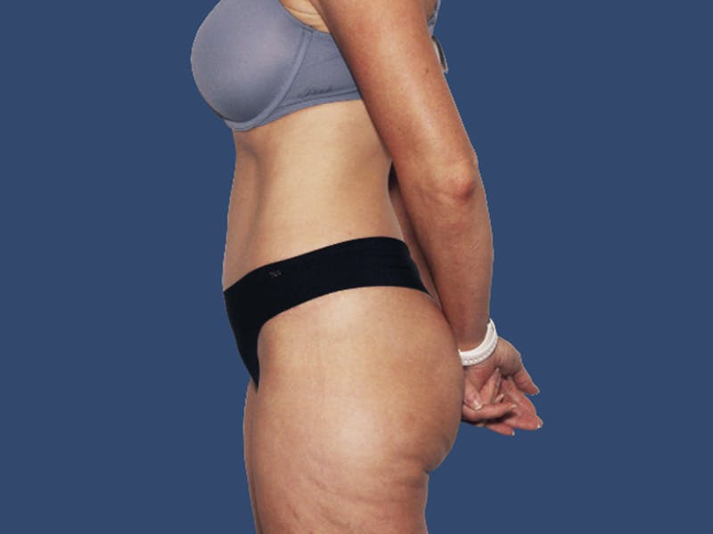Tummy Tuck Before & After Gallery - Patient 167056 - Image 4
