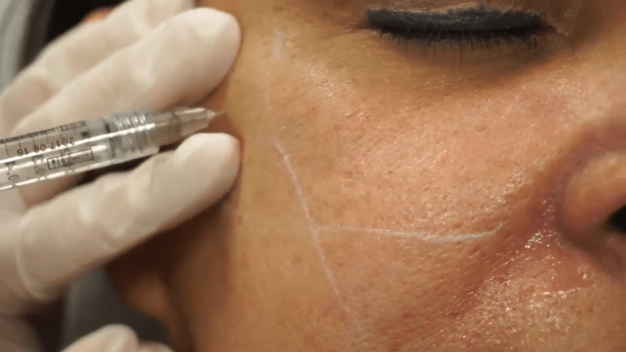 Woman receiving Juvederm injectables