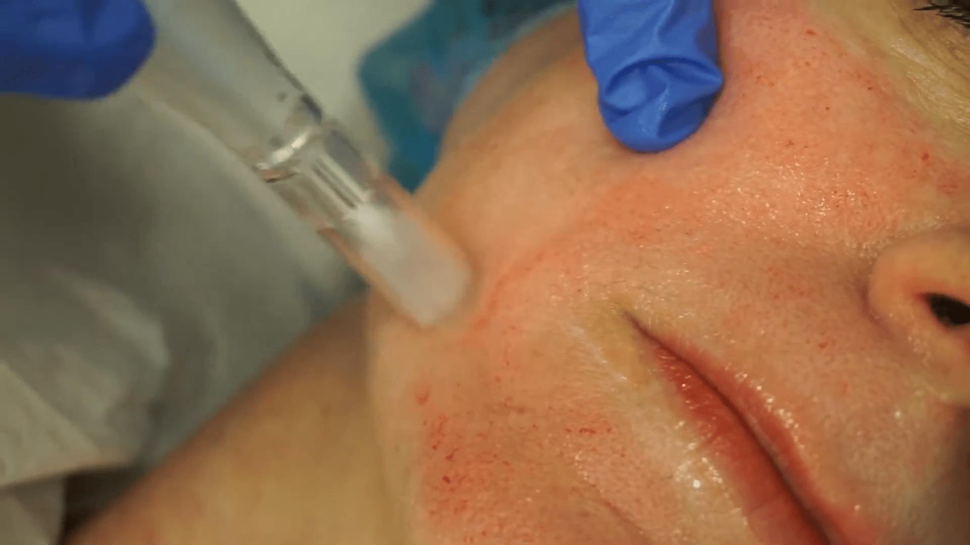 Woman Receiving Microneedling