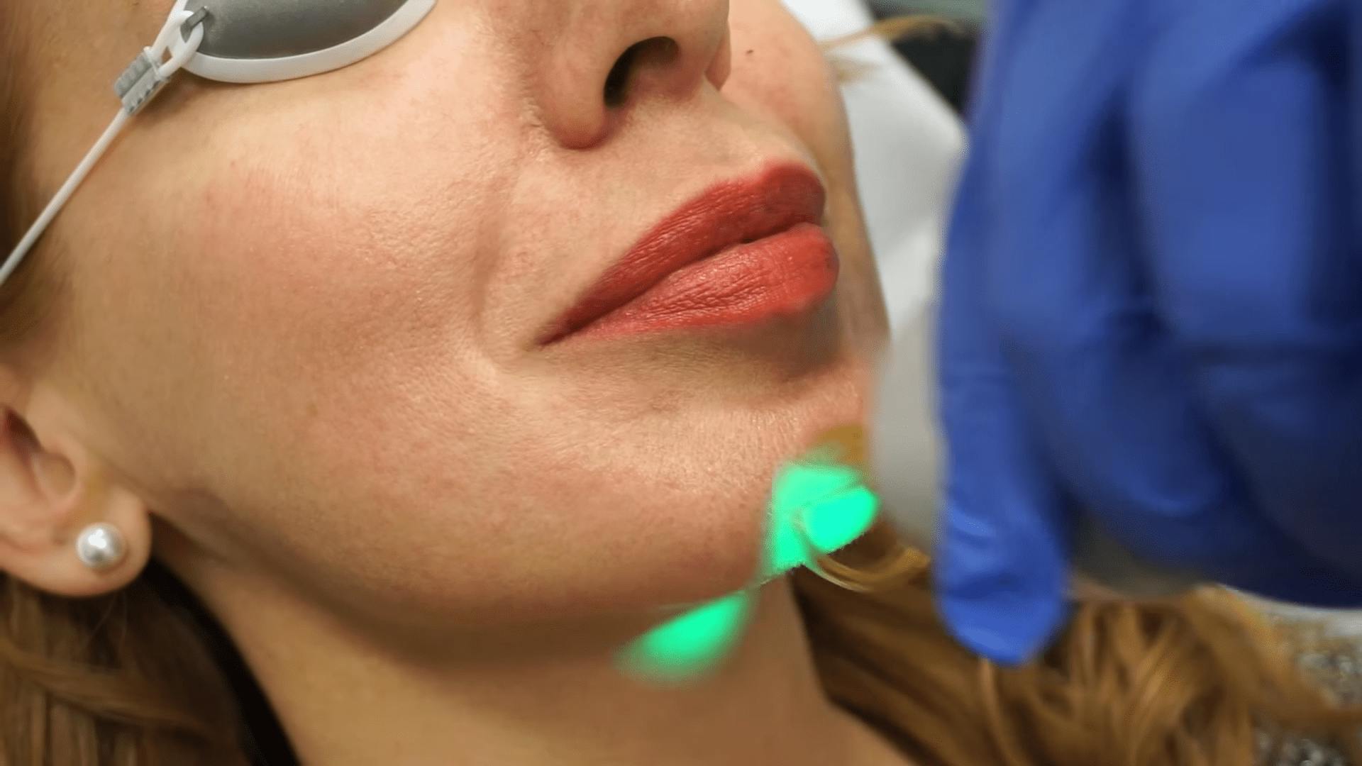 Woman Receiving Laser Hair Removal