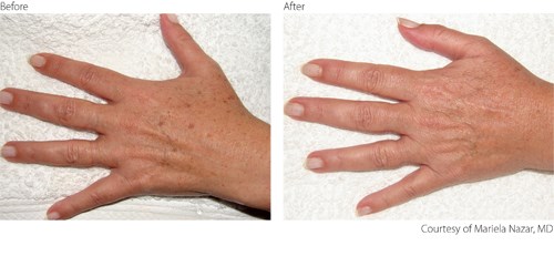 beforeafter2-pigmentation-hands-courtesy-of-mariela-nazar-m-d