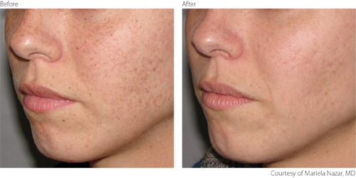 beforeafter1-pigmentation-freckles-courtesy-of-mariela-nazar-m-d