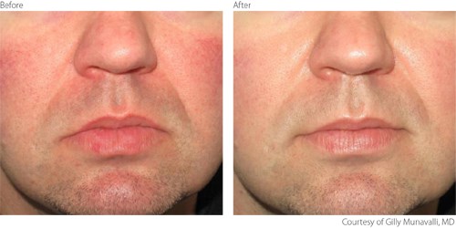 beaforeafter2-rosacea-courtesy-of-gilly-munavalli-m-d