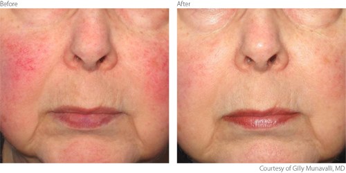 beaforeafter1-rosacea-courtesy-of-gilly-munavalli-m-d