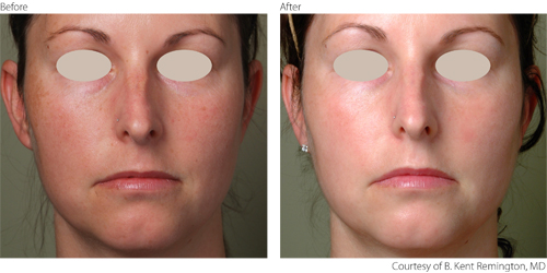 beforeafter3-photorejuvenation-courtesy-of-b-kent-remington-md