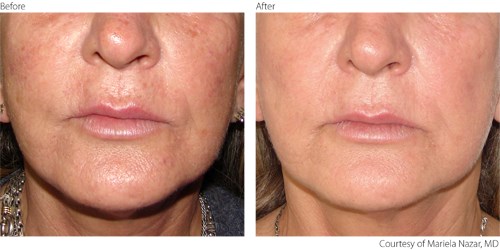 beforeafter2-photorejuvenation-courtesy-of-mariela-nazar-m-d