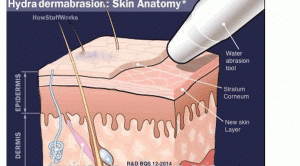 hydra-dermabrasion-stuff