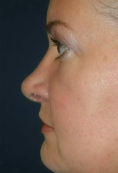 Woman After Rhinoplasty