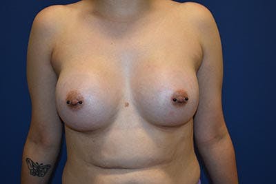 Breast Augmentation by Dr. Booth Before & After Gallery - Patient 55455168 - Image 2