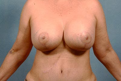  Breast Lift with Augmentation Dr. Booth Before & After Gallery - Patient 102647551 - Image 2
