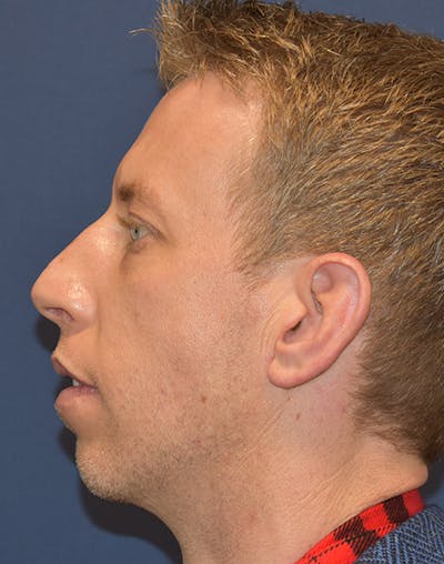 Chin Augmentation by Dr. Booth Before & After Gallery - Patient 55455175 - Image 1