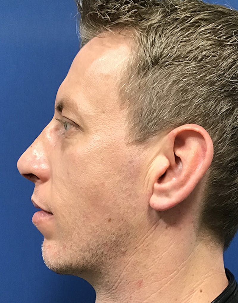 Chin Augmentation by Dr. Booth Before & After Gallery - Patient 55455175 - Image 2