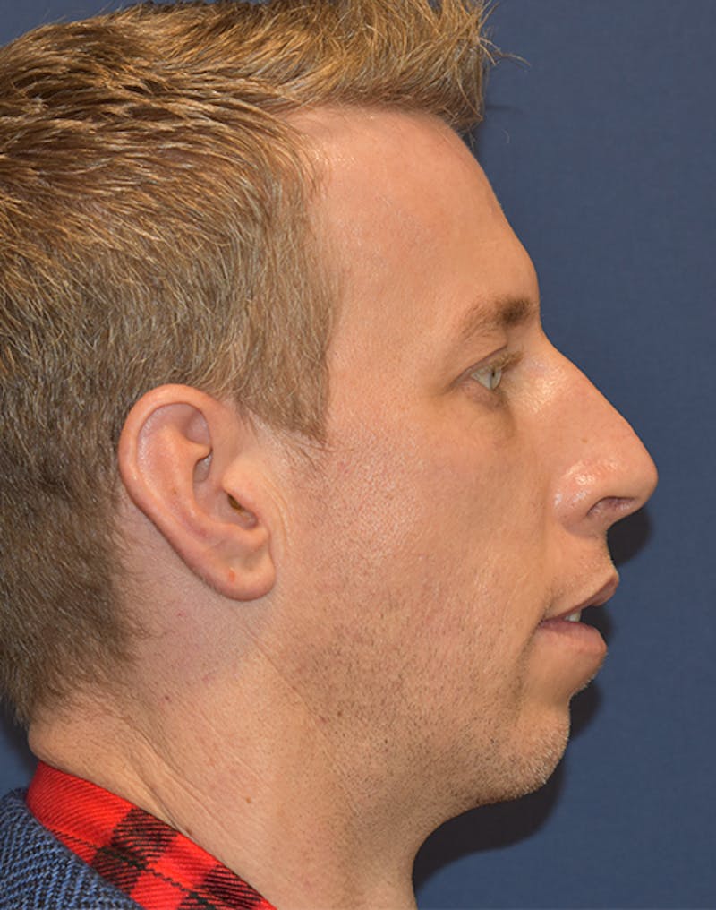 Chin Augmentation by Dr. Booth Before & After Gallery - Patient 55455175 - Image 3