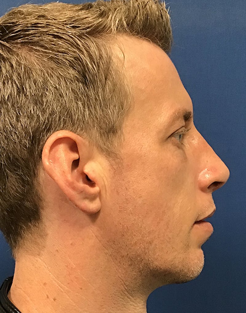 Chin Augmentation by Dr. Booth Before & After Gallery - Patient 55455175 - Image 4