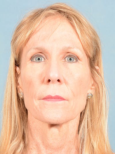Rhinoplasty by Dr. Booth Gallery - Patient 55455177 - Image 2