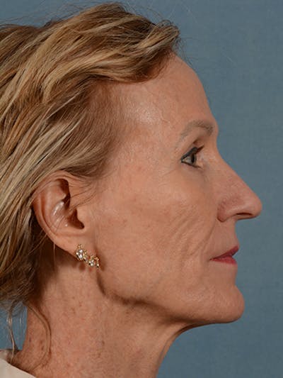 Rhinoplasty by Dr. Booth Before & After Gallery - Patient 55455177 - Image 1