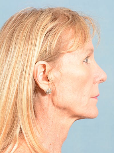 Rhinoplasty by Dr. Booth Before & After Gallery - Patient 55455177 - Image 2