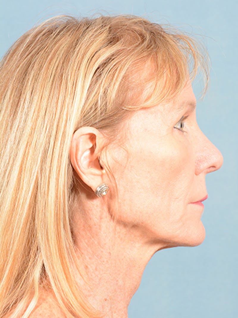 Rhinoplasty by Dr. Booth Before & After Gallery - Patient 55455177 - Image 4