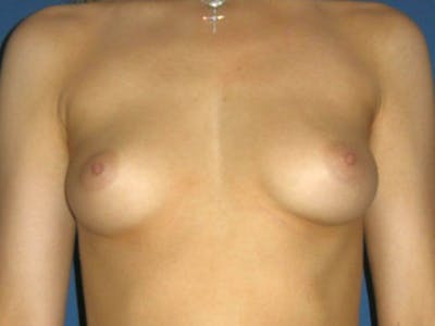Breast Augmentation by Dr. Haydon Before & After Gallery - Patient 55455178 - Image 1
