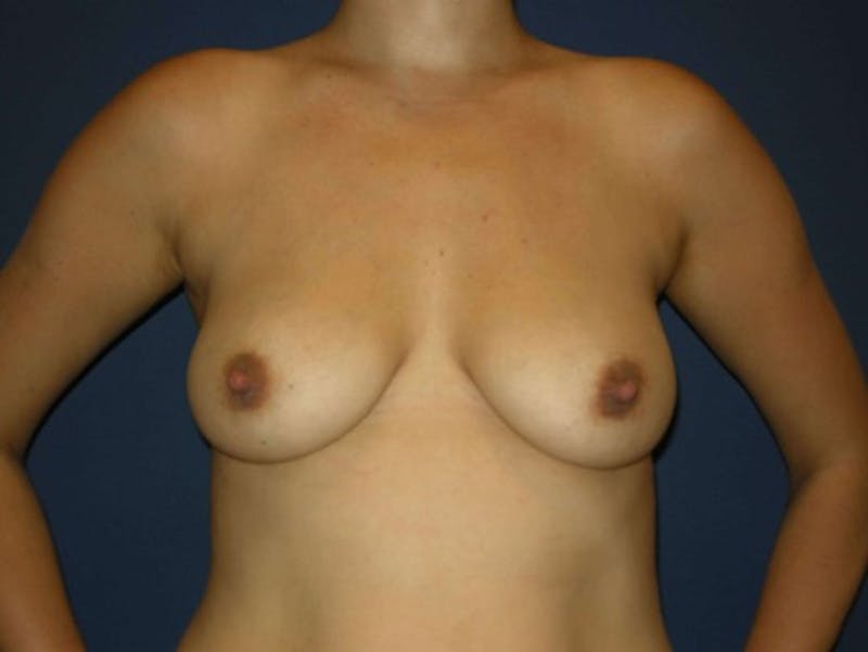 Breast Augmentation by Dr. Haydon Before & After Gallery - Patient 55455180 - Image 1