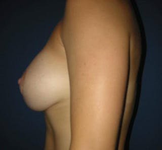 Breast Lift by Dr. Haydon Before & After Gallery - Patient 55455179 - Image 4