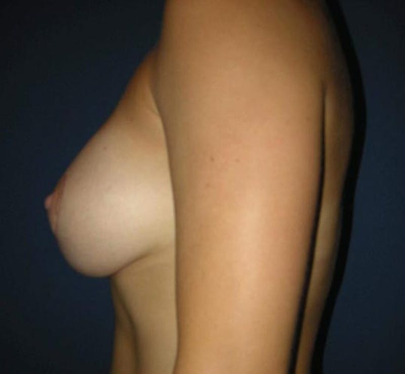 Breast Lift by Dr. Haydon Gallery - Patient 55455179 - Image 4