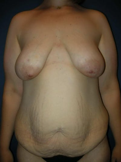 Breast Lift by Dr. Haydon Before & After Gallery - Patient 55455183 - Image 1