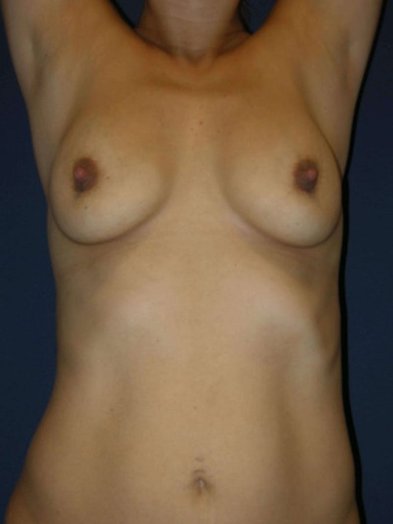 Breast Augmentation by Dr. Haydon Before & After Gallery - Patient 55455180 - Image 3