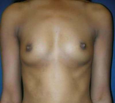 Breast Augmentation by Dr. Haydon Before & After Gallery - Patient 55455181 - Image 1