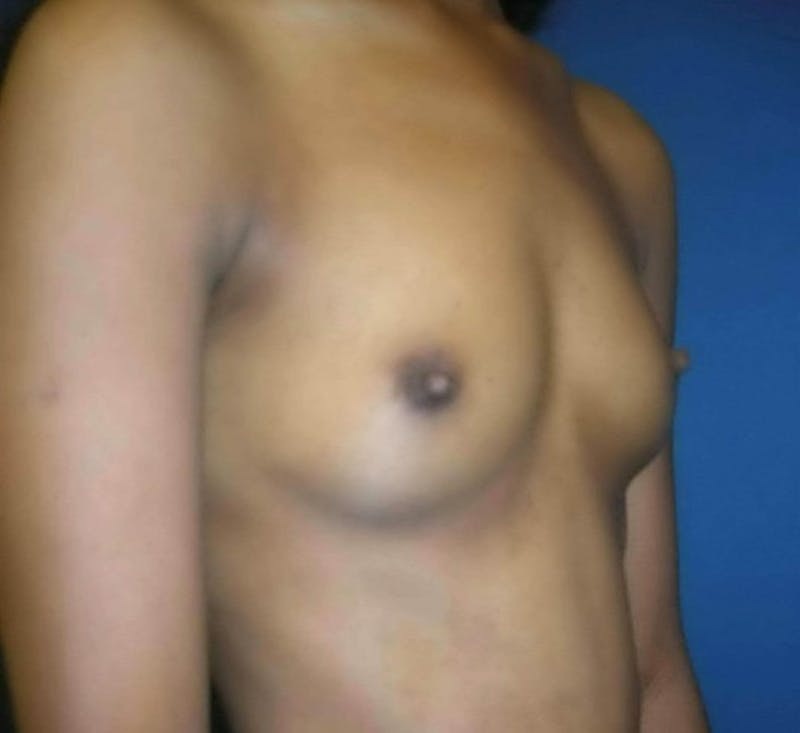Breast Augmentation by Dr. Haydon Before & After Gallery - Patient 55455181 - Image 3