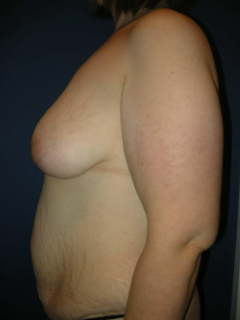 Breast Augmentation with Lift by Dr. Haydon Before & After Gallery - Patient 55455182 - Image 5