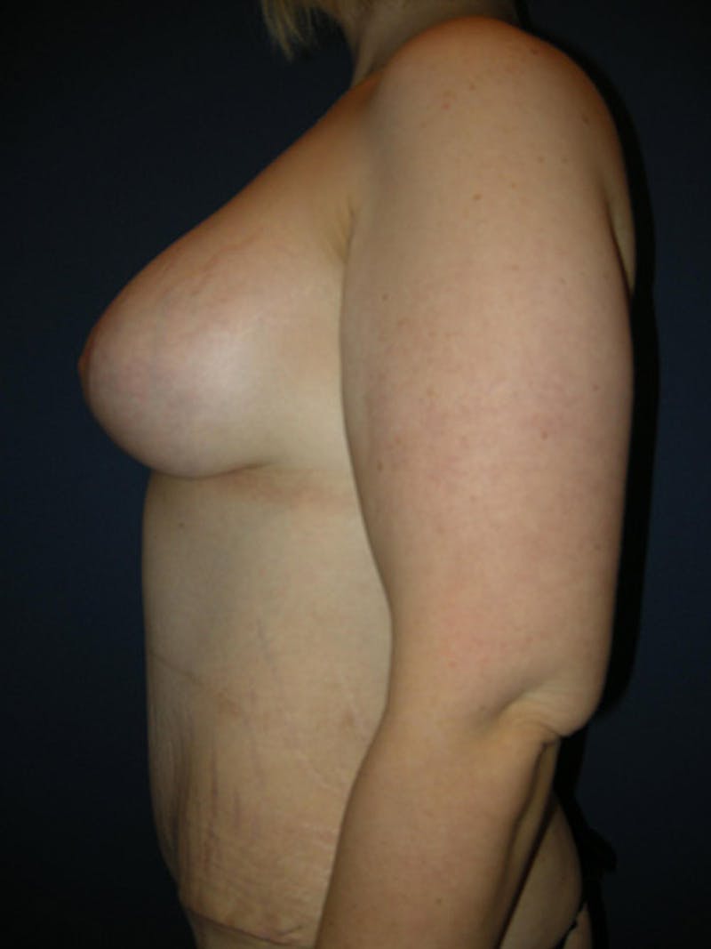 Breast Augmentation with Lift by Dr. Haydon Gallery - Patient 55455182 - Image 6