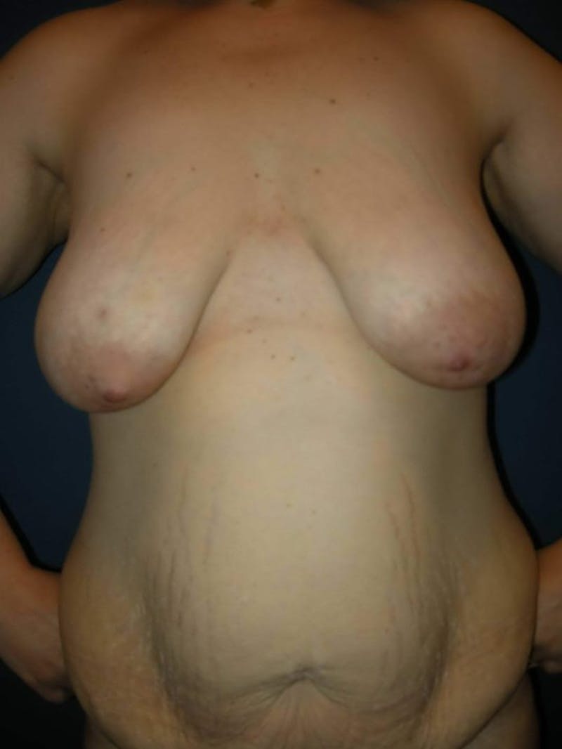 Breast Augmentation with Lift by Dr. Haydon Before & After Gallery - Patient 55455182 - Image 7