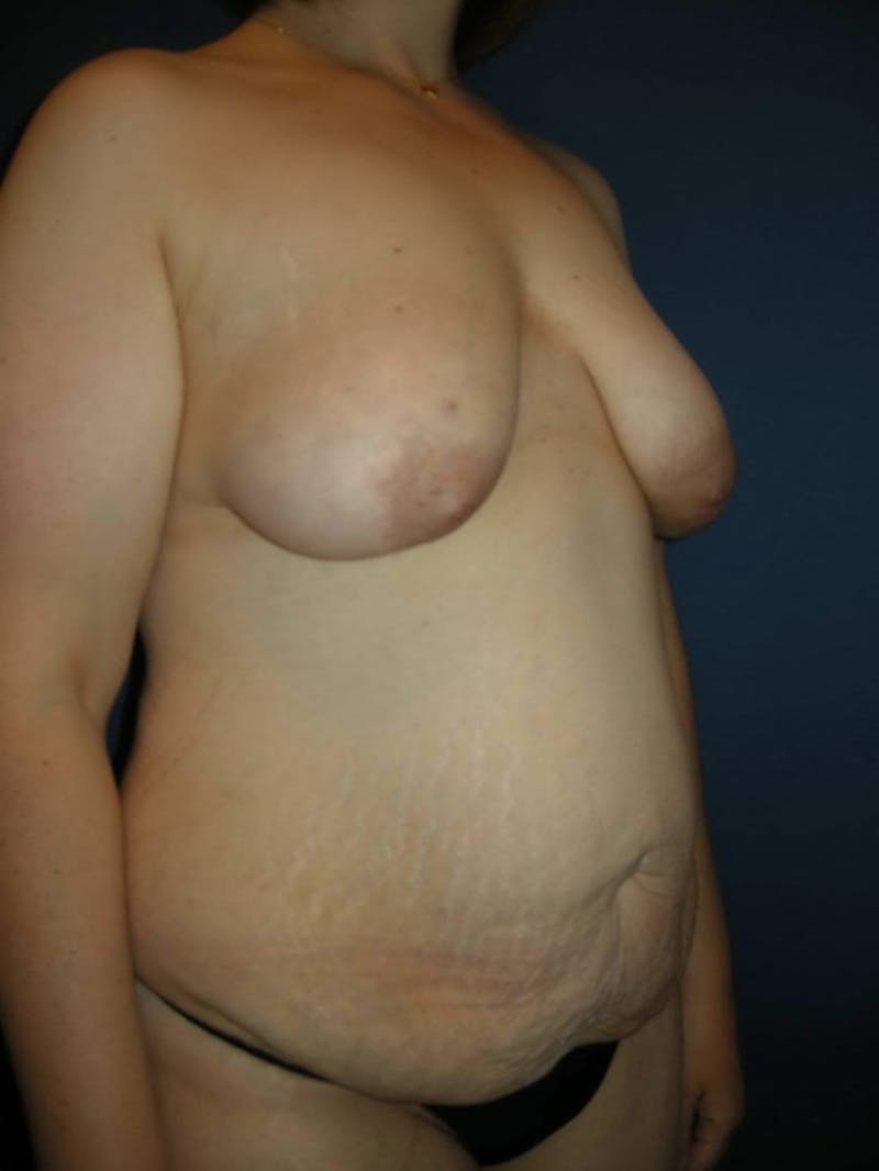 Breast Augmentation with Lift by Dr. Haydon Before & After Gallery - Patient 55455182 - Image 9