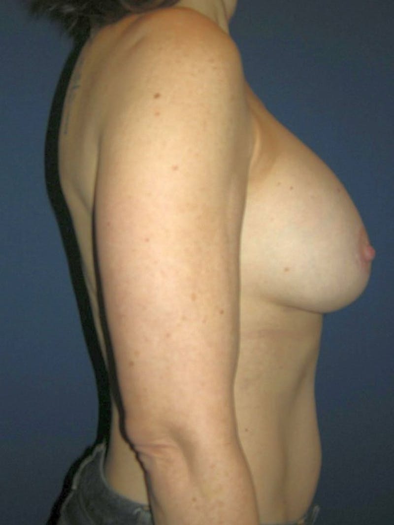 Breast Augmentation by Dr. Haydon Before & After Gallery - Patient 55455185 - Image 4